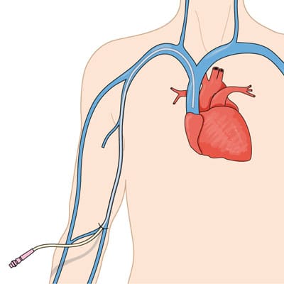 Curso Indicación y selección de la vía arterial